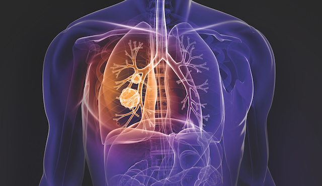 Immune Blockade in NonSmall Cell Lung Cancer