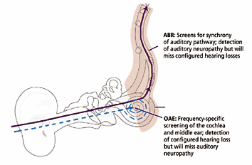 auditory neuropathy spectrum disorder