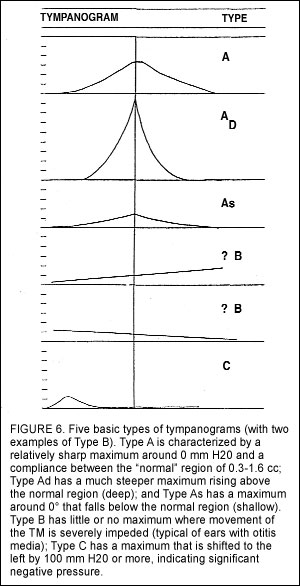 types of tympanograms