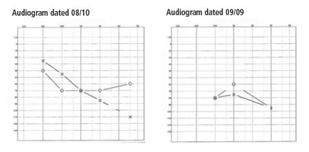 hearing aids for auditory processing disorder
