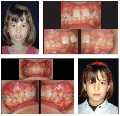headgear activator before ii orthodontic questions class using case 2008