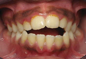open bite orthodontic fisher malocclusions myofunctional demonstrate typical treat figures bottom results