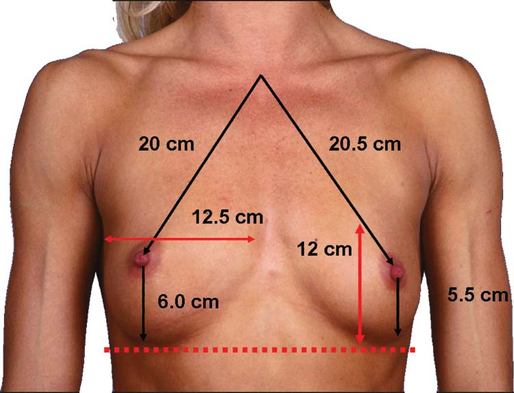 Full C Breast Augmentation 114