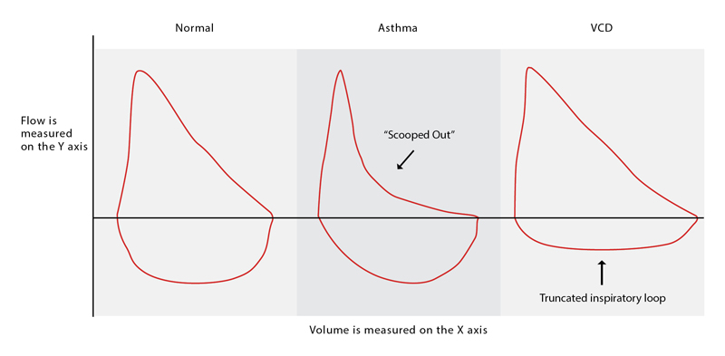 Asthma Or Vocal Cord Dysfunction? - Rt: For Decision Makers In 