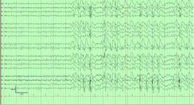nocturnal epilepsy in adults