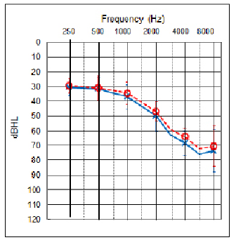 A Hearing Aid Solution for Music - Hearing Review