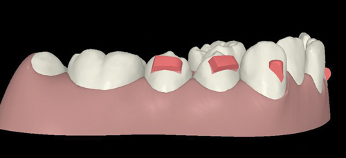 Dr Glaser’s 10 Commandments of Attachment Design - Orthodontic Products