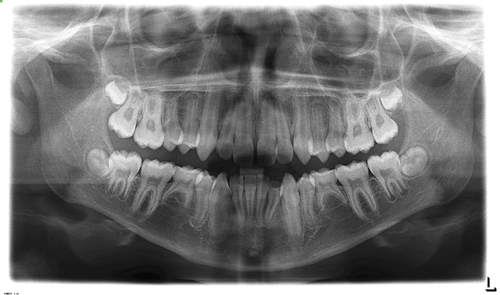 The Split-Edgewise Technique - Orthodontic Products