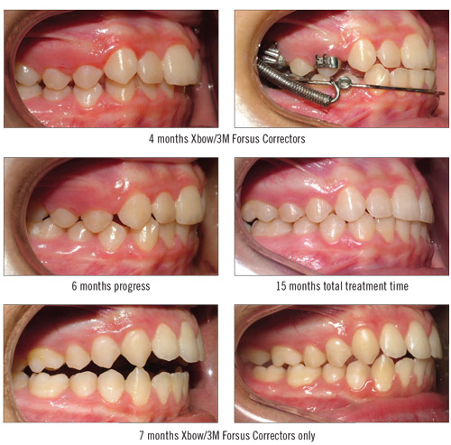 Class II Correction with Higgins Xbow and Forsus Correctors