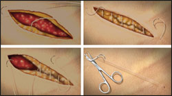 Evaluating the Quill Self-Retaining System - Plastic Surgery Practice