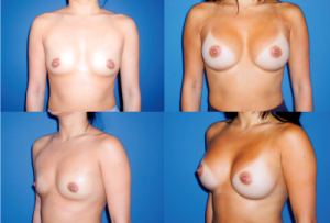 Class 2 breast shape