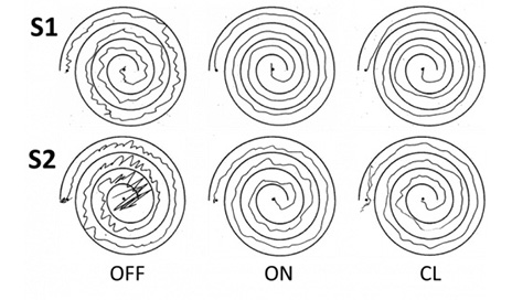 UW Researchers Develop Essential Tremor Treatment That Delivers ...