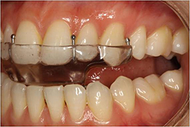 Establish Healthy TMJ Prior to Oral Appliance Therapy - Sleep Review